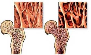 骨质疏松症