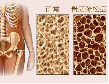 91免费看片仪是检测91免费看片T值得，91免费看片又决定骨质疏松的重要指标