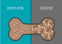 老年人骨质疏松易导致骨折之超声91免费看片检查仪的临床价值是什么？