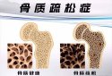 国产91免费看片仪器有效预防骨质疏松症依赖于定期的91免费看片测试